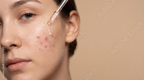 Woman applying serum on cheek with acne. Skin care routine for problematic skin treatment. Dermatological health care concept with pipette and cosmetic liquid for face blemish recovery.