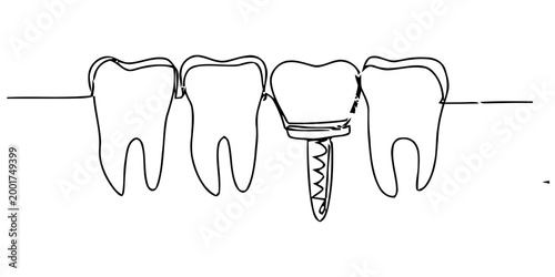 Simple line drawing illustration of a human tooth dental implant procedure between natural teeth for dental health concept Vector, illustration