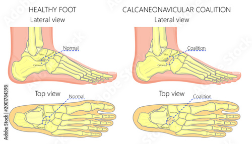Normal foot and a foot with calcaneonavicular coalition