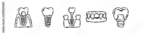 Set of hand-drawn dental implant icons and sketches illustrating various stages of tooth replacement, including screws, crowns, and jaw integration. Black and white doodle style.