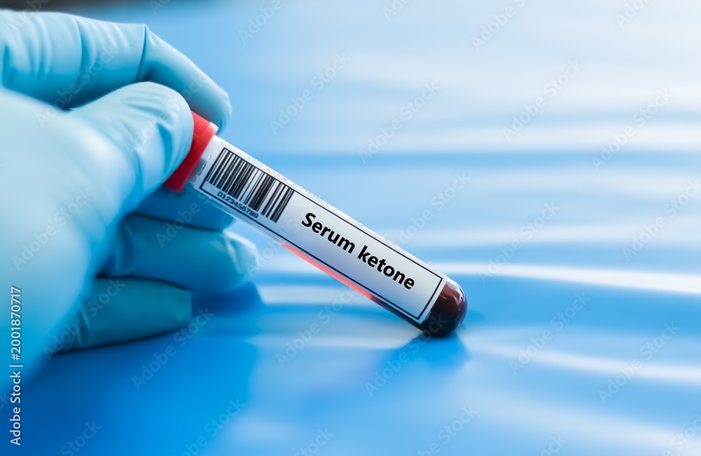 Obraz premium Blood sample tube for serum ketone test analysis.