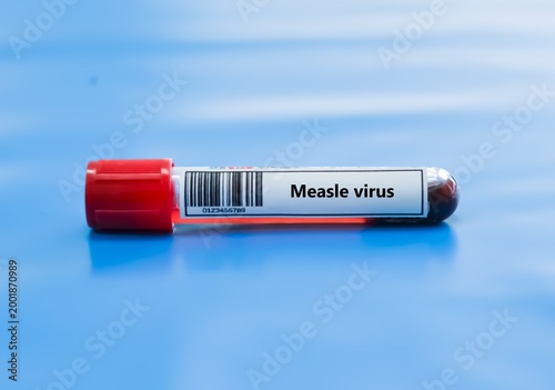Photos Blood sample tube for measle virus test analysis.