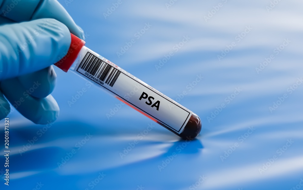 Obraz premium Blood sample tube for prostate specific antigen (PSA) test analysis.