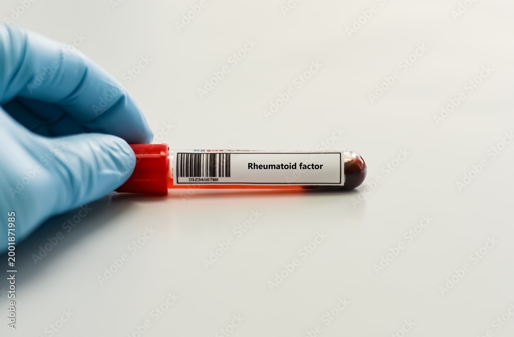 Obraz premium Blood sample tube for rheumatoid factor test analysis.