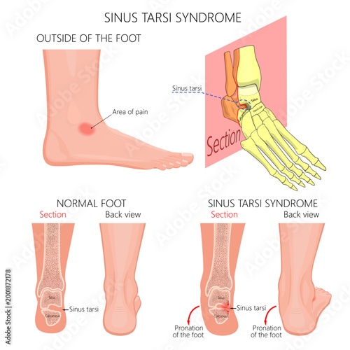 Sinus tarsi syndrome