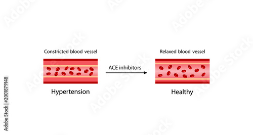 ACE inhibitors. Renin-Angiotensin-Aldosterone System, blood pressure regulation. Hypertension, Constricted and relaxed blood vessel. Vasoconstriction and vasodilatation. Vector illustration.