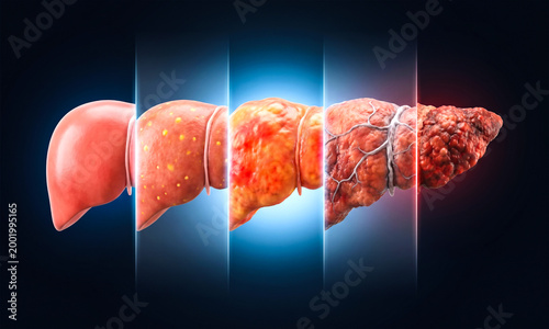 Stages of liver damage are depicted as a transition from healthy to sick.