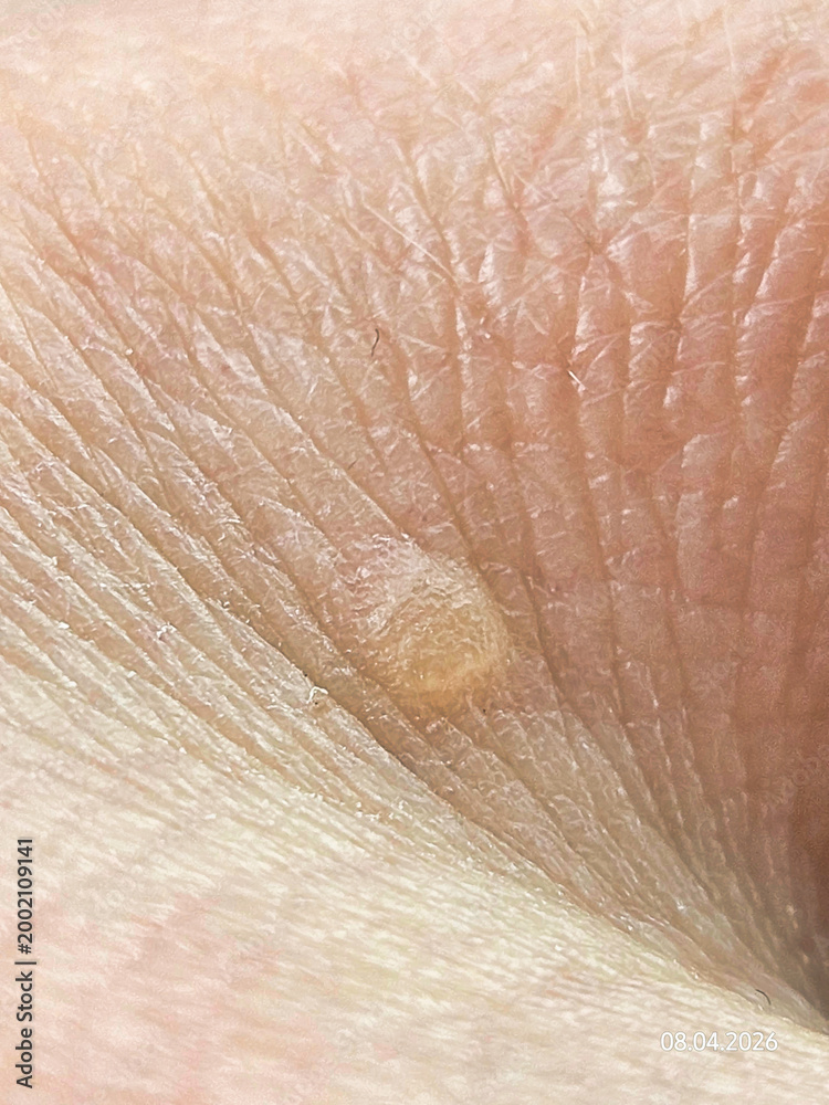 Fototapeta premium close up of human skin, papilloma, verruca