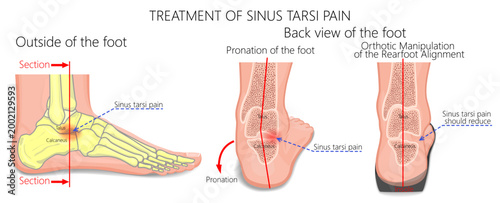 Sinus tarsi syndrome pain reduction. Orthotic Manipulation of the Rearfoot Alignment