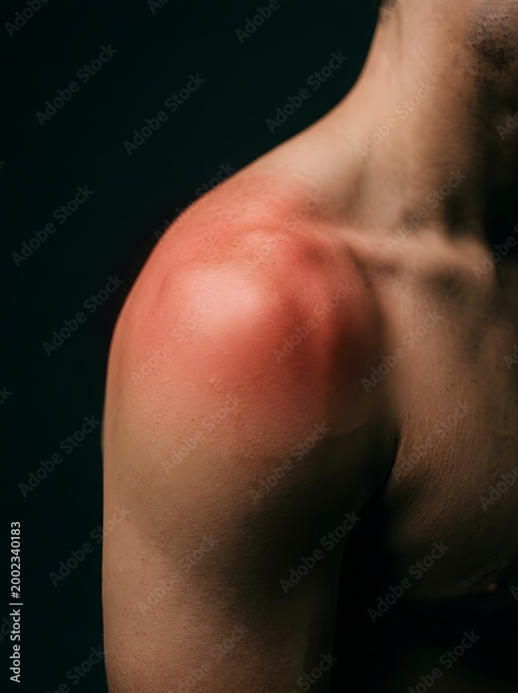 Naklejka premium Close-up of Man's Shoulder with Prominent Red Inflammatory Marking Representing Pain