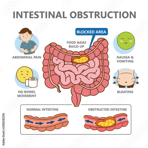 Comparison between normal intestine and obstructed intestine, infographic illustration cartoon on white background