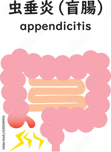 虫垂炎になった大腸