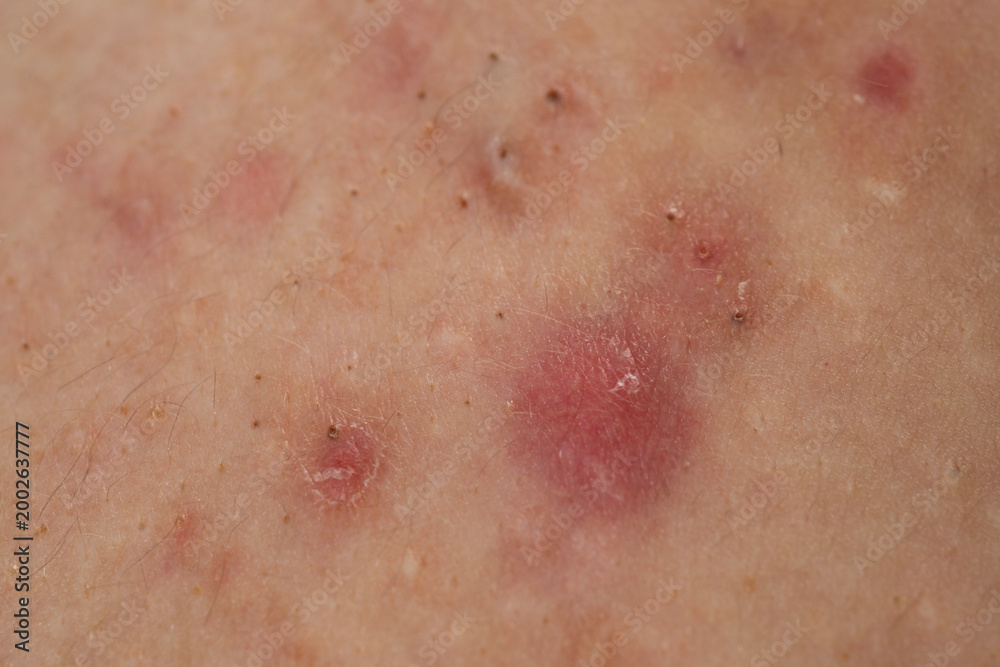 Fototapeta premium Macro shot of skin irritation with acne. Dermatology concept with acne skin pores. Skin rash texture with acne. Irritated acne skin.