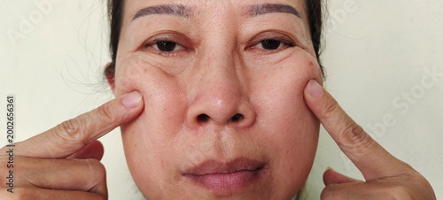 portrait the fingers holding the cheek, Flabby and Flabbiness skin, scar and loose, freckles and blemish on the face, health care and beauty concept.