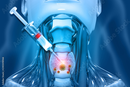 Fotografija Medical professional administering a targeted syringe injection into an inflamed human thyroid gland for treatment