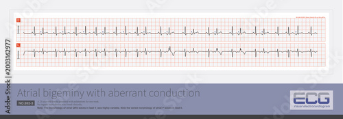 Foto A sinus beat and an atrial premature beat alternate