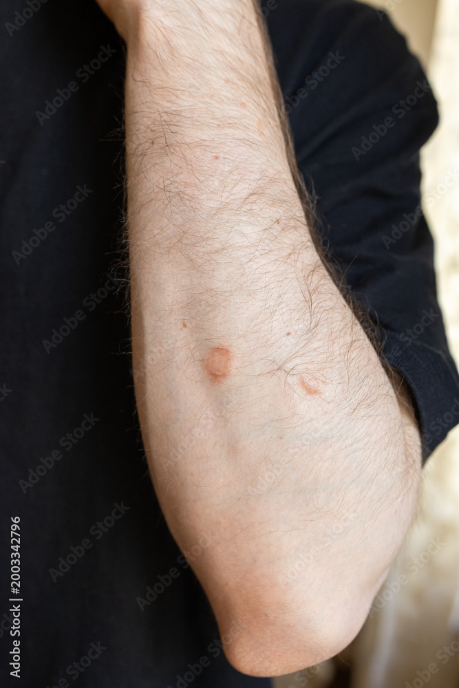 Naklejka premium Skin lesions on male arm close up, dermatology problem