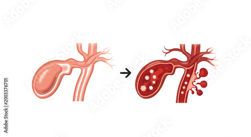 Medical illustration showing the development of gallbladder stones and resulting inflammation in the bile duct system.