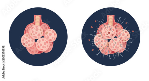 Microscopic view comparing healthy lung alveoli to damaged tissues with inflammatory needles in a medical diagram.