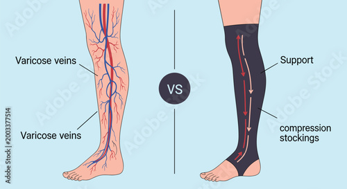 Comparative medical diagram of a human leg showing varicose veins versus a leg wearing a compression stocking.