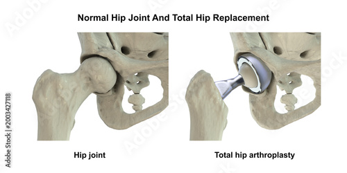 Картината върху платно Normal healthy hip joint with intact femoral head, acetabulum, articular cartilage and joint space, and total hip replacement, 3D illustration