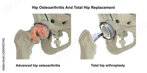 Photos Advanced hip osteoarthritis with joint space narrowing, osteophytes and cartilage loss, and total hip replacement prosthesis, 3D illustration