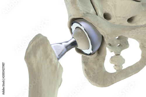 Total hip replacement prosthesis. Shows femoral stem with head, acetabular cup with liner, and articulation in the hip joint. 3D illustration.