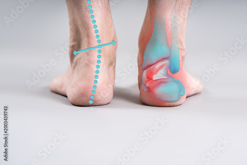 Orthopedic concept of ankle pain and foot biomechanics, joint inflammation and alignment lines