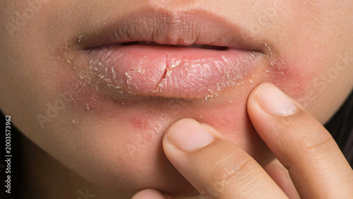 Closeup of dry chapped lips with peeling skin being touched by finger