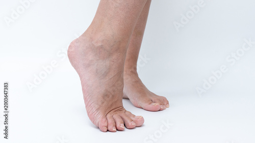 Bild auf Leinwand Varicose veins visible on female legs, showcasing skin texture and anatomical de