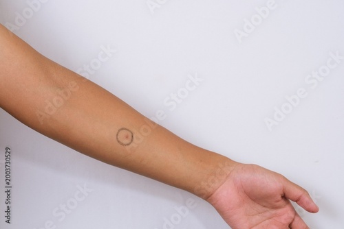 Close up of Mantoux test mark on human skin showing medical screening for tuberculosis with visible injection reaction on forearm.