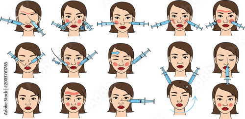 Cosmetic injection procedures vector set showing facial filler and botox treatment areas, beauty clinic aesthetic medicine illustrations with syringes and woman face diagrams