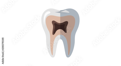 Cross-section of a damaged tooth showing decay and pulp cavity
