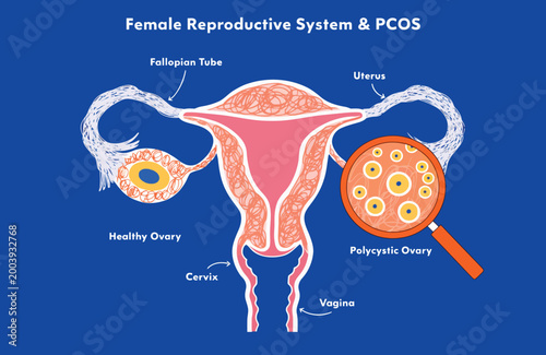 Understanding Polycystic Ovary Syndrome (PCOS) Diagram Showing Ovary, Uterus and Cysts