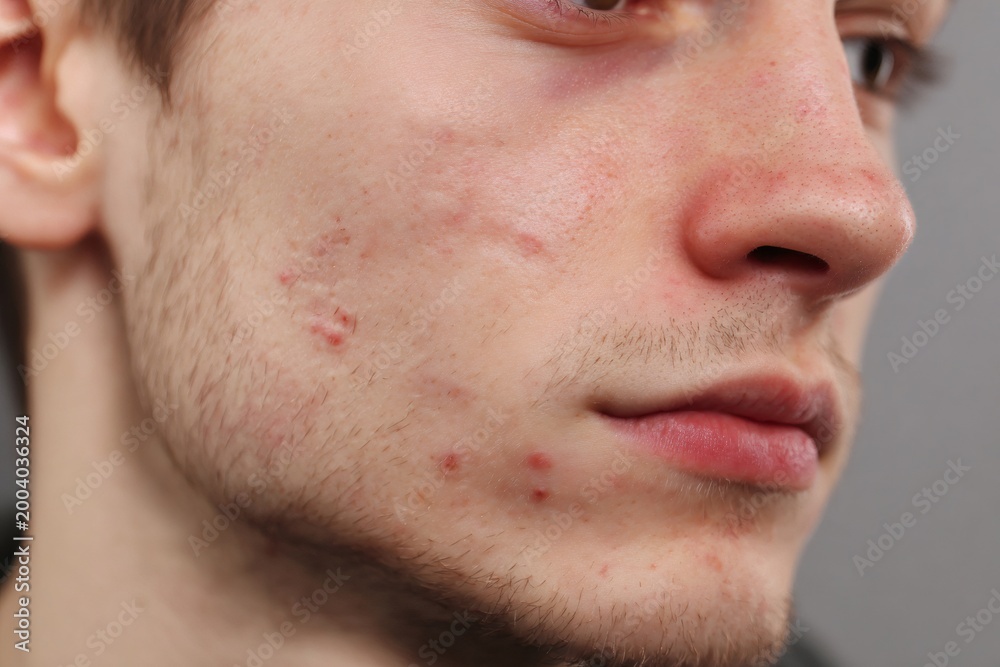 Obraz premium Young man experiencing skin problems with acne, pimples, and scarring on his face, showing skin imperfection