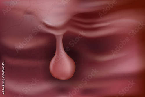 Detailed medical illustration of a polyp shown as a benign soft tissue growth arising from a mucosal surface. Polyp Benign Tissue Growth on Mucosal Surface Close Up