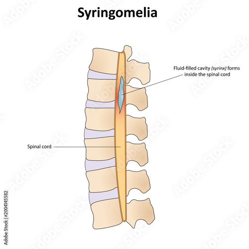 Syringomyelia vector illustration