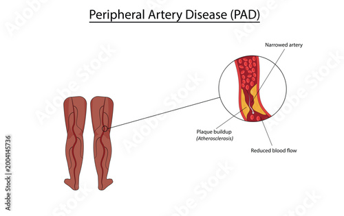 Peripheral artery disease vector illustration