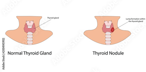 Thyroid nodules vector illustration