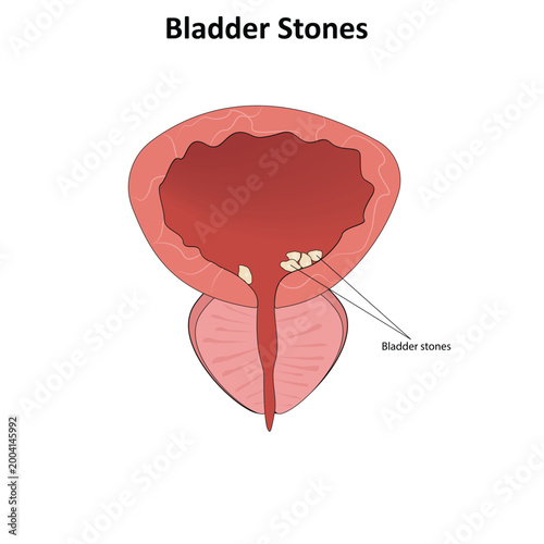 Bladder stones vector illustration