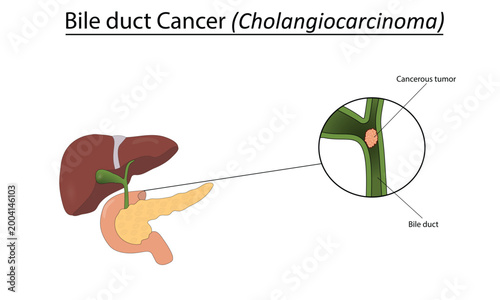 Bile duct cancer (cholangiocarcinoma) vector illustration