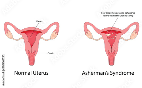 Asherman's syndrome vector illustration