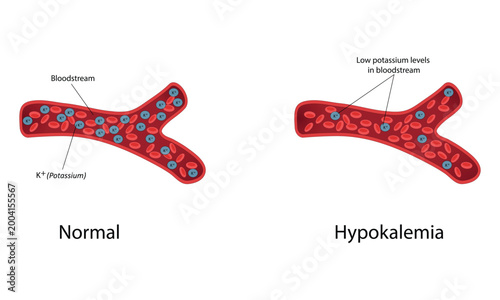 Hypokalemia vector illustration
