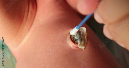 Tableau sur toile Cleaning newborn baby umbilical cord, first week of life