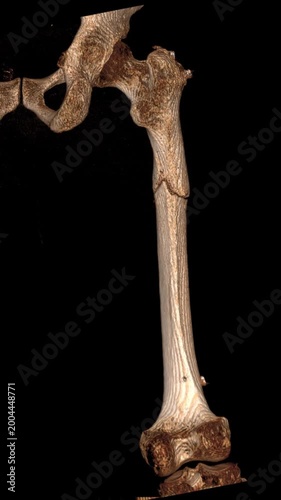 3D CT scan showing subtrochanteric femur fracture on black background. High resolution medical visualization of proximal femoral shaft break for orthopedic education clinical study trauma surgery plan