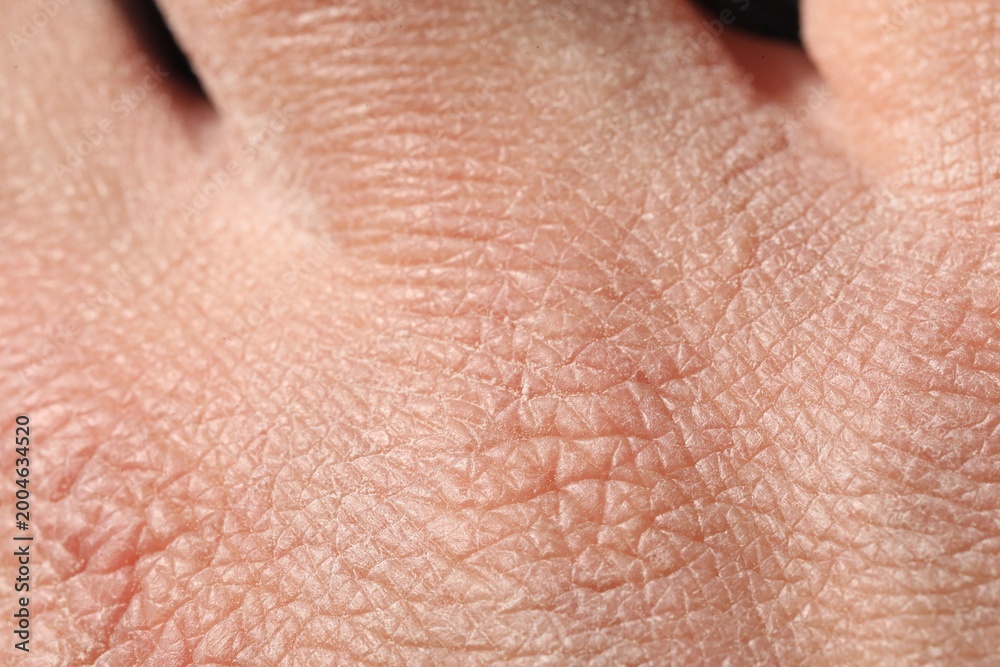 Fototapeta premium Man with dry skin on his hand, closeup