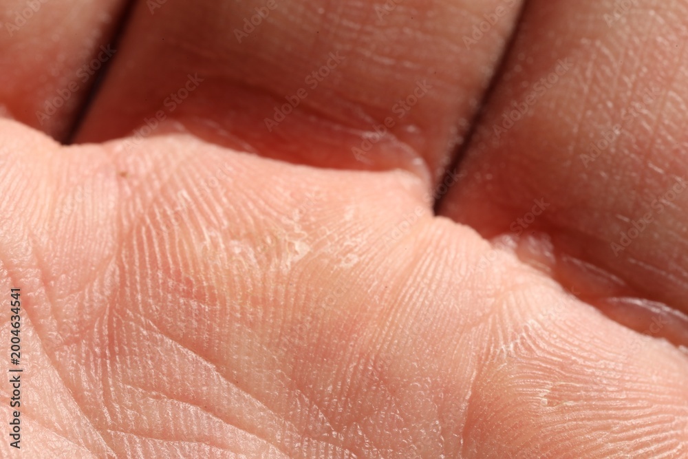 Fototapeta premium Man with dry skin on his hand, closeup