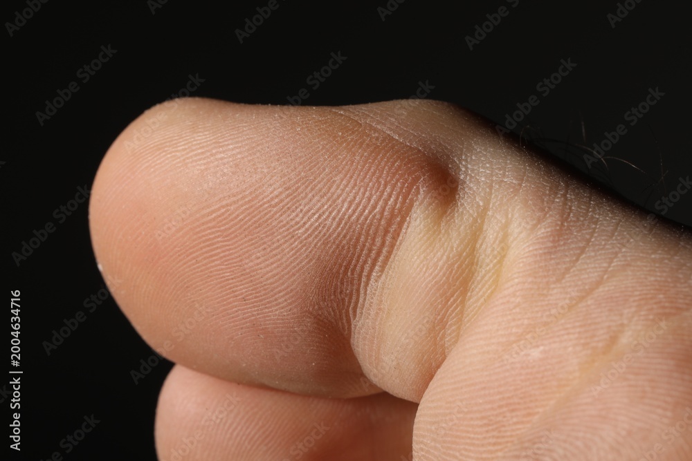 Naklejka premium Man with dry skin on his foot against black background, closeup