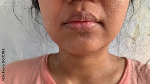 dry itchy skin, eczema in a face around the lip