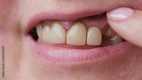 Unrecognizable woman with broken teeth. Female mouth with damaged and cracked tooth. Closeup
